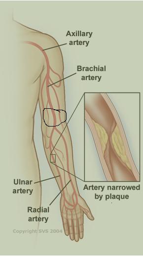 1344-biceps smerte.JPG