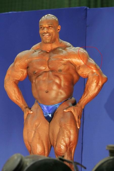 1973-907127.1138727523087.torntricep.jpg