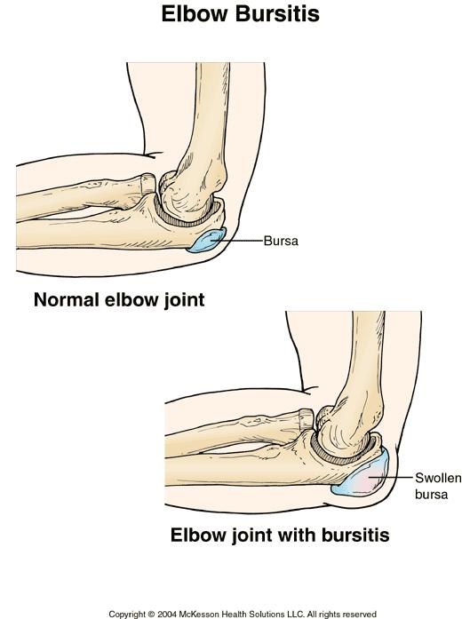 1505-elbow.JPG