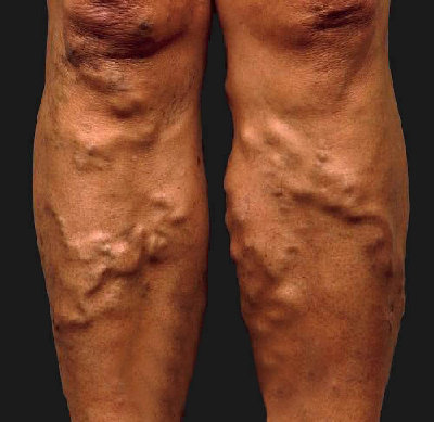 Varicose-Veins-legs.jpg